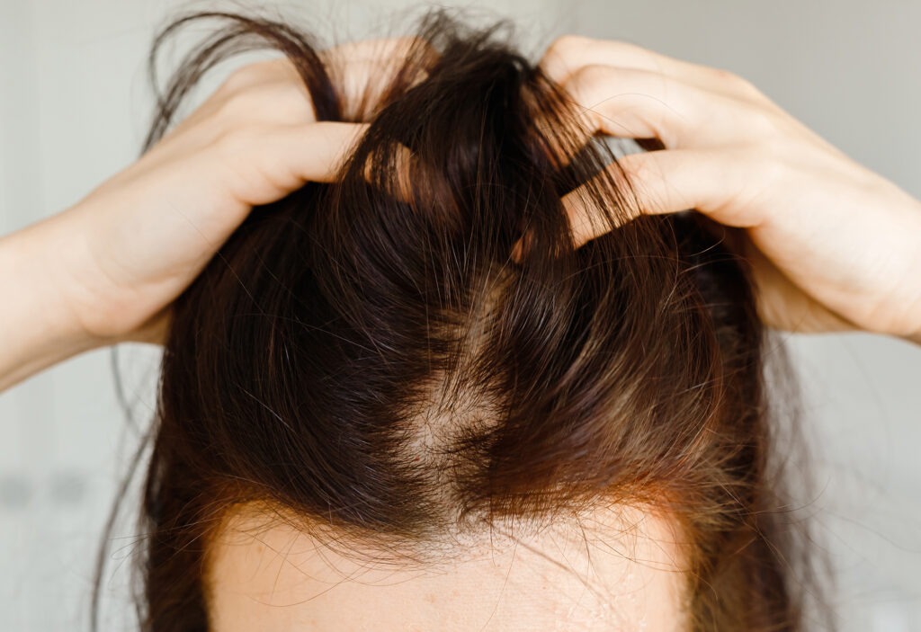 Serenity Emporium Hair Salon Cheadle hairloss2